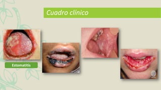 Cuadro clínico
Estomatitis
 