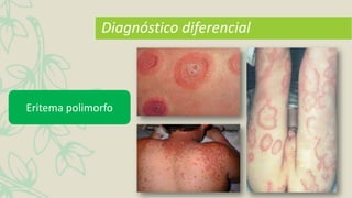 Diagnóstico diferencial
Eritema polimorfo
 