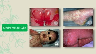 Síndrome de Lylle
 