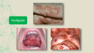 Penfigoide
 