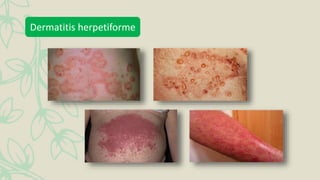 Dermatitis herpetiforme
 