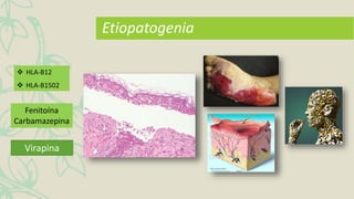  HLA-B12
 HLA-B1502
Fenitoína
Carbamazepina
Etiopatogenia
Virapina
 