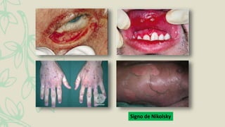 Signo de Nikolsky
 