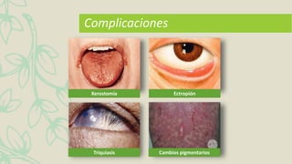 Complicaciones
Xerostomía Ectropión
Triquiasis Cambios pigmentarios
 