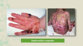 Epidermólisis ampollar
 