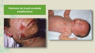 Síndrome de la piel escalada
estafilocócica
 