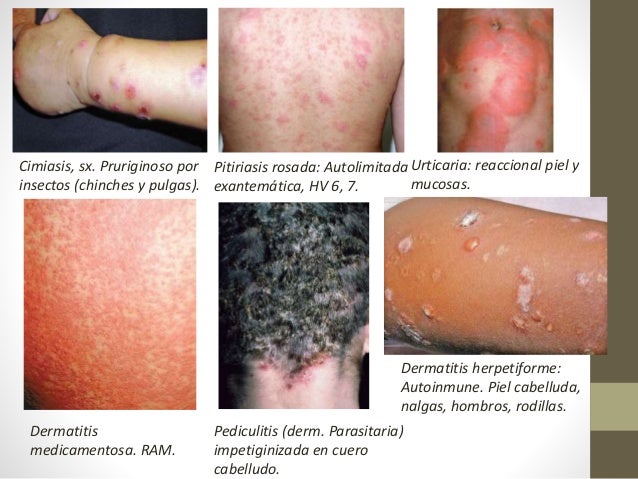 El agua a la psoriasis