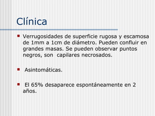 Clínica
   Verrugosidades de superficie rugosa y escamosa
    de 1mm a 1cm de diámetro. Pueden confluir en
    grandes masas. Se pueden observar puntos
    negros, son capilares necrosados.

   Asintomáticas.

    El 65% desaparece espontáneamente en 2
    años.
 