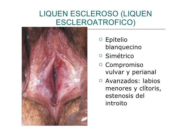 Lichen Planus Picture Image on MedicineNet.com