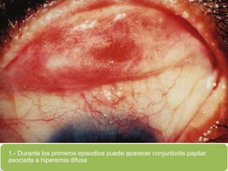 1.- Durante los primeros episodios puede aparecer conjuntivitis papilar
asociada a hiperemia difusa
 