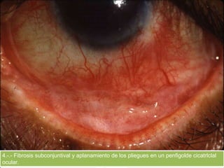 4.-.- Fibrosis subconjuntival y aplanamiento de los pliegues en un penfigolde cicatrlclal
ocular.
 