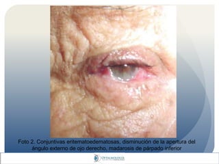 Foto 2. Conjuntivas eritematoedematosas, disminución de la apertura del
ángulo externo de ojo derecho, madarosis de párpado inferior
 