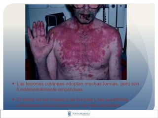  Las lesiones cutáneas adoptan muchas formas, pero son
fundamentalmente ampollosas
 El dorso de las manos y de los pies y las superficies
extensoras de los brazos son los más afectados
 