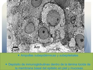  Ampollas subepidérmicas y subepiteliales
 Depósito de inmunoglobulinas dentro de la lámina lúcida de
la membrana basal del epitelio en piel y mucosas.
 