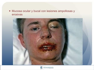  Mucosa ocular y bucal con lesiones ampollosas y
erosivas
 