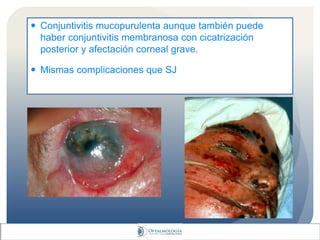  Conjuntivitis mucopurulenta aunque también puede
haber conjuntivitis membranosa con cicatrización
posterior y afectación corneal grave.
 Mismas complicaciones que SJ
 