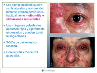  Los signos oculares suelen
ser bilaterales y comprenden
blefaritis crónica persistente,
habitualmente meibomitis y
chalaziones recurrentes
 Los márgenes palpebrales
aparecen rojos y ligeramente
engrosados y pueden existir
telangiectasias
 3-58% de pacientes con
rosácea.
 Conjuntivitis crónica NO
secreción.
 