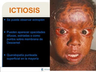 ICTIOSIS
 Se puede observar ectropión
 Pueden aparecer opacidades
difusas, estriadas o como
puntos sobre membrana de
Descemet
 Queratopatía punteada
superficial en la mayoría
 