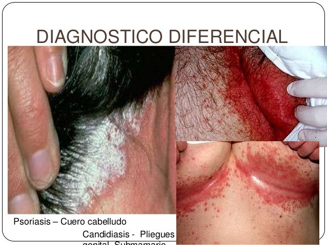 La eccema del párpados de los ojo de la foto