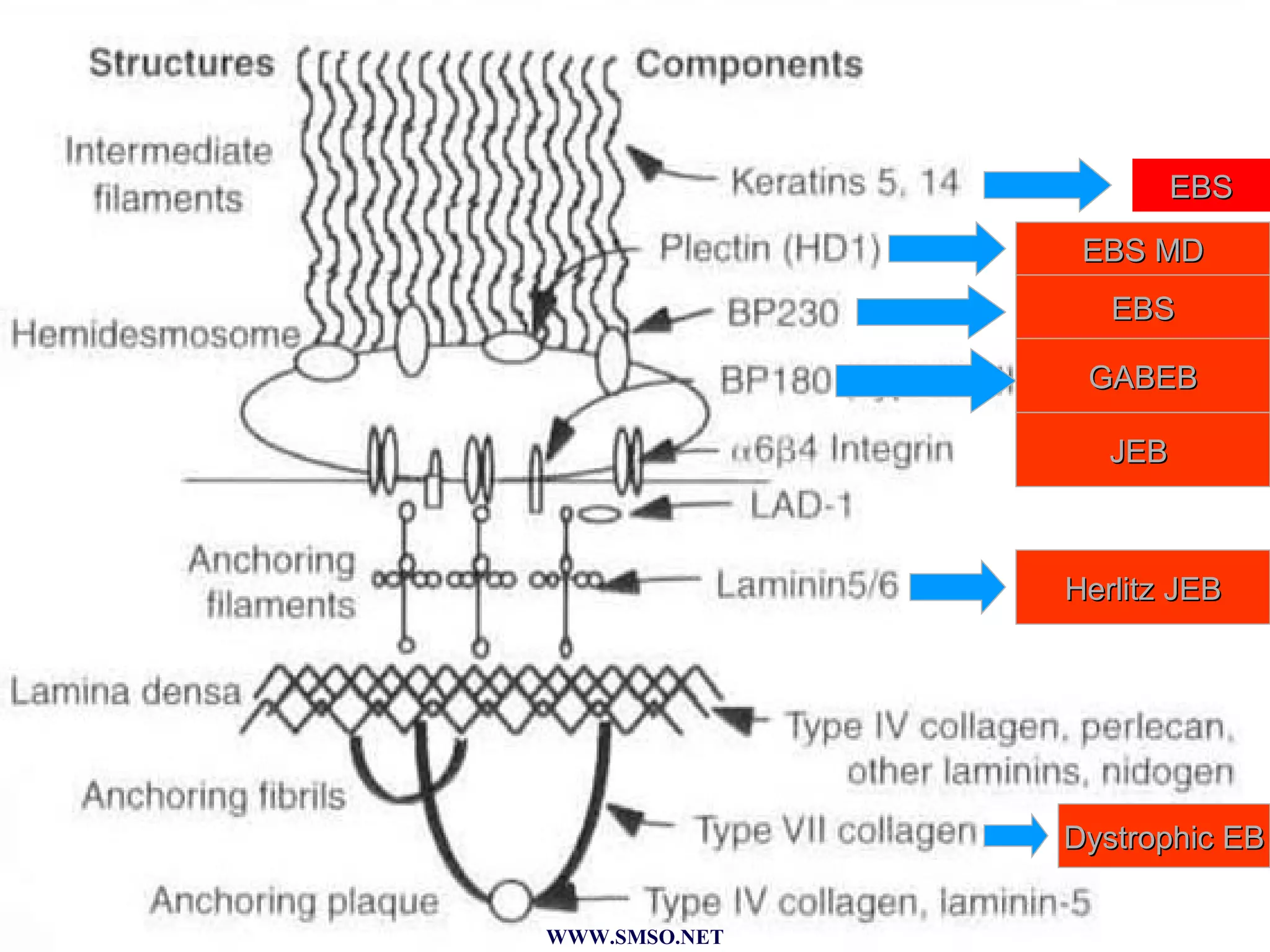 EBS EBS MD EBS GABEB JEB  Herlitz JEB Dystrophic EB WWW.SMSO.NET 