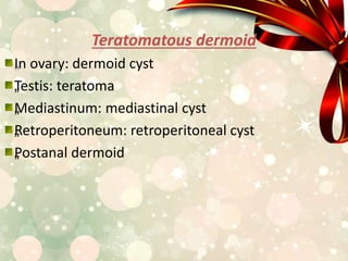 Teratomatous dermoid
„In ovary: dermoid cyst
„Testis: teratoma
„Mediastinum: mediastinal cyst
„Retroperitoneum: retroperitoneal cyst
„Postanal dermoid
