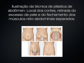 Ilustração da técnica de plástica deIlustração da técnica de plástica de
abdômen. Local dos cortes, retirada doabdômen. Local dos cortes, retirada do
excesso de pele e do fechamento dosexcesso de pele e do fechamento dos
músculos reto-abdominais separados.músculos reto-abdominais separados.
 