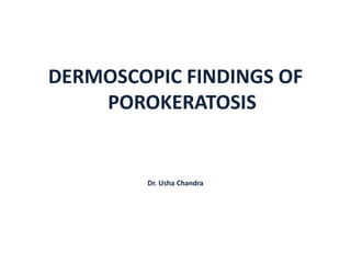 DERMOSCOPIC FINDINGS OF
POROKERATOSIS
Dr. Usha Chandra
 