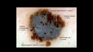 Dermoscopy an overview | PPTX