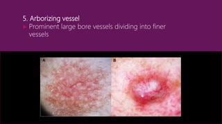 Arborizing Dermoscopy an overview | PPTX