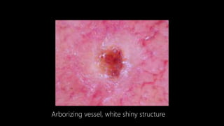 Arborizing Dermoscopy an overview | PPTX
