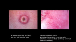 Arborizing Dermoscopy an overview | PPTX