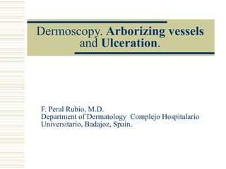 Dermoscopy.  Arborizing vessels  and  Ulceration . F. Peral Rubio, M.D. Department of Dermatology  Complejo Hospitalario Universitario, Badajoz, Spain. 