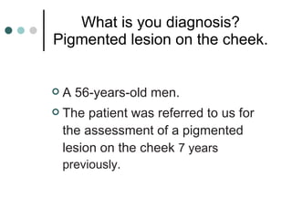 What is you diagnosis? Pigmented lesion on the cheek. A 56-years-old men. The patient was referred   to us for the assessment of a  pigmented lesion on the cheek  7 years  previously. 