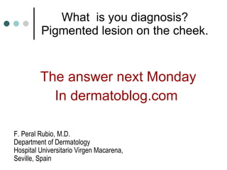 What  is you diagnosis? Pigmented lesion on the cheek. The answer next Monday In dermatoblog.com  F. Peral Rubio, M.D. Department of Dermatology  Hospital Universitario Virgen Macarena,  Seville, Spain 
