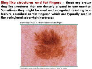 Comprehensive Dermoscopy of Facial Skin Lesions: Diagnosis and Patterns ...