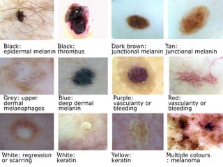 Black:
Black:
epidermal melanin thrombus

Grey: upper
dermal
melanophages

Blue:
deep dermal
melanin

White: regression White:
or scarring
keratin

Dark brown:
Tan:
junctional melanin junctional melanin

Purple:
vascularity or
bleeding

Yellow:
keratin

Red:
vascularity or
bleeding

Multiple colours
: melanoma

 