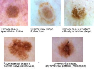 Homogeneous,
symmetrical lesion

Symmetrical shape
& structure

Asymmetrical shape &
pattern (atypical naevus)

Homogeneous structure
with asymmetrical shape

Symmetrical shape,
asymmetrical pattern (melanoma)

 