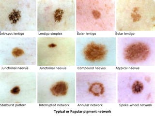 Ink-spot lentigo

Junctional naevus

Junctional naevus
Starburst pattern

Lentigo simplex

Solar lentigo

Solar lentigo

Junctional naevus

Compound naevus

Atypical naevus

Compound naevus
Interrupted network

Atypical naevus
Annular network

Typical or Regular pigment network

Atypical naevus
Spoke-wheel network

 