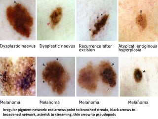 Dysplastic naevus Dysplastic naevus Recurrence after
excision

Melanoma

Melanoma

Melanoma

Atypical lentiginous
hyperplasia

Melanoma

Irregular pigment network: red arrows point to branched streaks, black arrows to
broadened network, asterisk to streaming, thin arrow to pseudopods

 