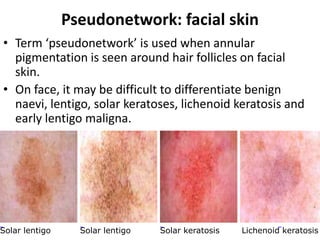 Pseudonetwork: facial skin
• Term ‘pseudonetwork’ is used when annular
pigmentation is seen around hair follicles on facial
skin.
• On face, it may be difficult to differentiate benign
naevi, lentigo, solar keratoses, lichenoid keratosis and
early lentigo maligna.

Solar lentigo

Solar lentigo

Solar keratosis

Lichenoid keratosis

 