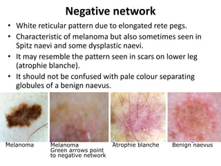 Negative network
• White reticular pattern due to elongated rete pegs.
• Characteristic of melanoma but also sometimes seen in
Spitz naevi and some dysplastic naevi.
• It may resemble the pattern seen in scars on lower leg
(atrophie blanche).
• It should not be confused with pale colour separating
globules of a benign naevus.

Melanoma

Melanoma
Green arrows point
to negative network

Atrophie blanche

Benign naevus

 