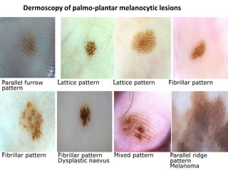 Dermoscopy of palmo-plantar melanocytic lesions

Parallel furrow
pattern

Lattice pattern

Lattice pattern

Fibrillar pattern

Mixed pattern
Fibrillar pattern
Dysplastic naevus

Fibrillar pattern

Parallel ridge
pattern
Melanoma

 