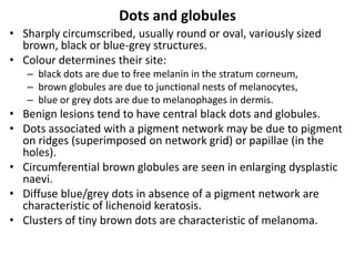 Dots and globules
• Sharply circumscribed, usually round or oval, variously sized
brown, black or blue-grey structures.
• Colour determines their site:
– black dots are due to free melanin in the stratum corneum,
– brown globules are due to junctional nests of melanocytes,
– blue or grey dots are due to melanophages in dermis.

• Benign lesions tend to have central black dots and globules.
• Dots associated with a pigment network may be due to pigment
on ridges (superimposed on network grid) or papillae (in the
holes).
• Circumferential brown globules are seen in enlarging dysplastic
naevi.
• Diffuse blue/grey dots in absence of a pigment network are
characteristic of lichenoid keratosis.
• Clusters of tiny brown dots are characteristic of melanoma.

 