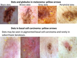Dots and globules in melanoma: yellow arrows
Black dots

Brown dots

Grey dots

Peripheral dots

Dots in basal cell carcinoma: yellow arrows
Dots may be seen in pigmented basal cell carcinoma and rarely in
seborrhoeic keratoses.

 