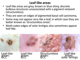 Leaf-like areas

• Leaf-like areas are grey, brown or blue shiny, discrete
bulbous structures unassociated with a pigment network
(structureless).
• They are seen on edges of pigmented basal cell carcinoma,
• Some may not appear very like a leaf, in which case they are
better known as ‘structureless areas’.
• Moth-eaten edges of solar lentigos also sometimes appear
leaf-like.

Leaf-like
areas:
BCC

Leaf-like
areas:
BCC

Structureless
areas:
BCC

Leaf-like
areas:
solar lentigo

 