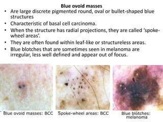 •
•
•

•
•

Blue ovoid masses
Are large discrete pigmented round, oval or bullet-shaped blue
structures
Characteristic of basal cell carcinoma.
When the structure has radial projections, they are called ‘spokewheel areas’.
They are often found within leaf-like or structureless areas.
Blue blotches that are sometimes seen in melanoma are
irregular, less well defined and appear out of focus.

Blue ovoid masses: BCC

Spoke-wheel areas: BCC

Blue blotches:
melanoma

 