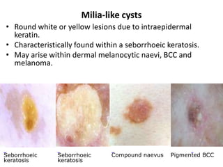 Milia-like cysts
• Round white or yellow lesions due to intraepidermal
keratin.
• Characteristically found within a seborrhoeic keratosis.
• May arise within dermal melanocytic naevi, BCC and
melanoma.

Seborrhoeic
keratosis

Seborrhoeic
keratosis

Compound naevus

Pigmented BCC

 