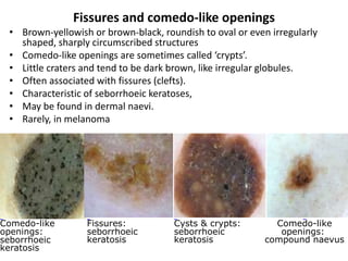 Fissures and comedo-like openings
• Brown-yellowish or brown-black, roundish to oval or even irregularly
shaped, sharply circumscribed structures
• Comedo-like openings are sometimes called ‘crypts’.
• Little craters and tend to be dark brown, like irregular globules.
• Often associated with fissures (clefts).
• Characteristic of seborrhoeic keratoses,
• May be found in dermal naevi.
• Rarely, in melanoma

Comedo-like
openings:
seborrhoeic
keratosis

Fissures:
seborrhoeic
keratosis

Cysts & crypts:
seborrhoeic
keratosis

Comedo-like
openings:
compound naevus

 