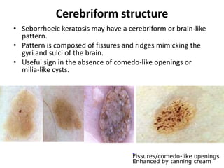 Cerebriform structure
• Seborrhoeic keratosis may have a cerebriform or brain-like
pattern.
• Pattern is composed of fissures and ridges mimicking the
gyri and sulci of the brain.
• Useful sign in the absence of comedo-like openings or
milia-like cysts.

Fissures/comedo-like openings
Enhanced by tanning cream

 