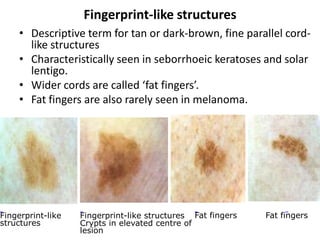 Fingerprint-like structures
• Descriptive term for tan or dark-brown, fine parallel cordlike structures
• Characteristically seen in seborrhoeic keratoses and solar
lentigo.
• Wider cords are called ‘fat fingers’.
• Fat fingers are also rarely seen in melanoma.

Fingerprint-like
structures

Fingerprint-like structures Fat fingers
Crypts in elevated centre of
lesion

Fat fingers

 